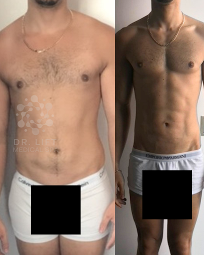 Abdomen Contouring