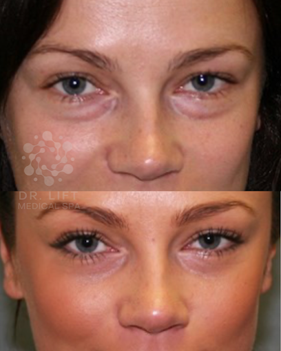 Eye Rejuvenation