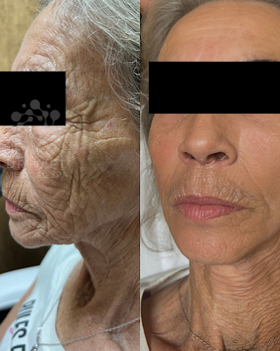 Facial Rejuvenation