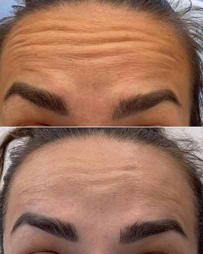 Forehead Lines