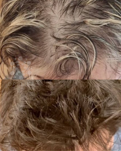 Hair Restoration