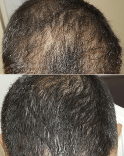 Hair Restoration