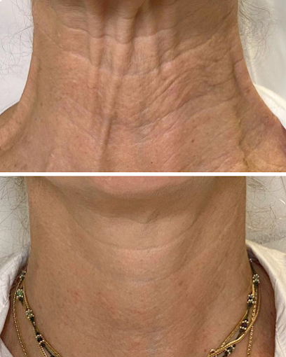 Neck Rejuvenation