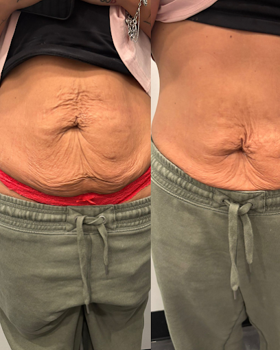 Body Contouring